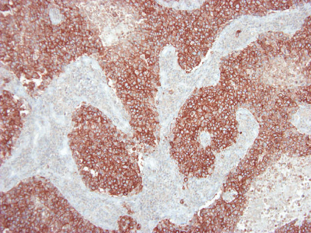 Figure 1. Immunohistochemistry of MUB1319P on formalin fixed, paraffin embedded tissue section of human breast carcinoma. Dilution 1:100.